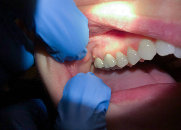Best Emergency Dental Care for Abscessed Tooth in Hopkinsville, KY